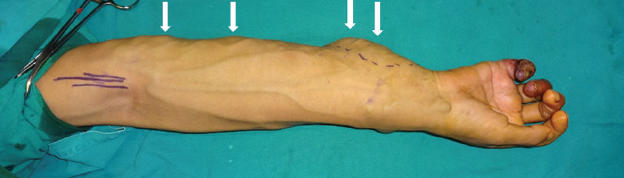 Multiple painful swellings of the right forearm, ulnar clawing, ulceration and gangrene of the little finger. Multiple dilated and tortuous veins, pulsatile lesions and warm mass (white arrows) with a thrill on examination were also seen.